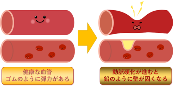 高血圧症の血管イメージ